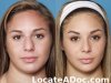 nose-job-rhinoplasty-before-fullsize-17634-32990.jpg