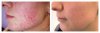 derma_roller1.jpg