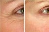 Anti-Aging-Before-and-After-Face-Derma-Roller-Wrinkles-Collegen-Induction.jpg