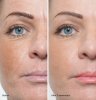 before-and-after-dermaroller.jpg