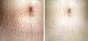 stretch-mark-treatment-before-after-derma-roller.jpg