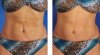 before-after-stretch-mark.jpg