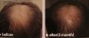 scientia-hair-laser-results.jpg