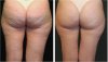 derma_roller_cellulite.jpg