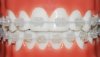 Clear-invisible-braces.jpg