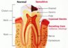 Dentin sensitivity (Dentin Hypersensitivity).jpg