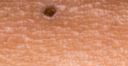 Blackheads-on-chest-causes-symptoms-diagnosis-treatement-and-remedies-537x324.jpg