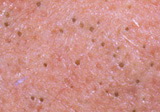 blackheads-on-forehead.jpg