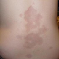 212354-325x321-Morphea.JPG