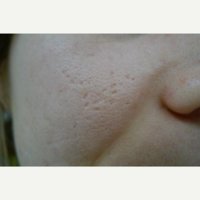 Acne-Scars-Treatment-before-1751328-2242690.jpg