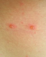 Chickenpox-in-adults.jpg