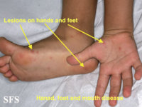 Hand_foot_mouth_disease-1.jpg
