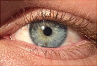 280x190_eye_freckles_ref_guide.jpg