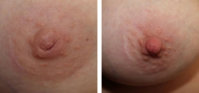 inverted-nipple-correction.jpg
