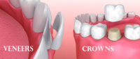 veneers-vs-crowns.jpg