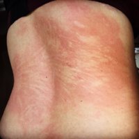 why-does-my-back-itch-with-red-marks.jpg