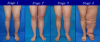 588px-Lower_Limb_Lymphedema.png