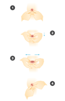 02_FULL-WIDTH_inverted-nipples-hoffman-technique.png