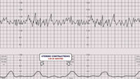 CTG-Uterine-Contractions.jpg