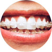 Braces1_compressed.png