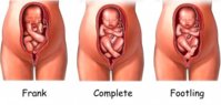 breech presentation.jpg