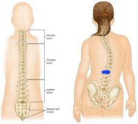 scoliosis.jpg