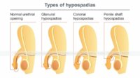 Hypospadias+types-866w.jpg