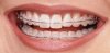 typesofbraces.jpg