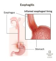 10138-esophagitis.jpg