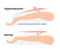 elbow-hyperextension600.jpg