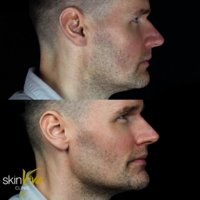 Male-jawline-treatment-with-dermal-fillers.jpg