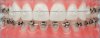 Choose-Typodont-Teeth.jpg