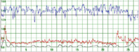 The-upper-part-of-the-graph-depicts-a-normal-fetal-heart-rate-The-middle-part.ppm.png