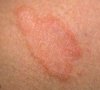 lichen_planus-20285.jpg